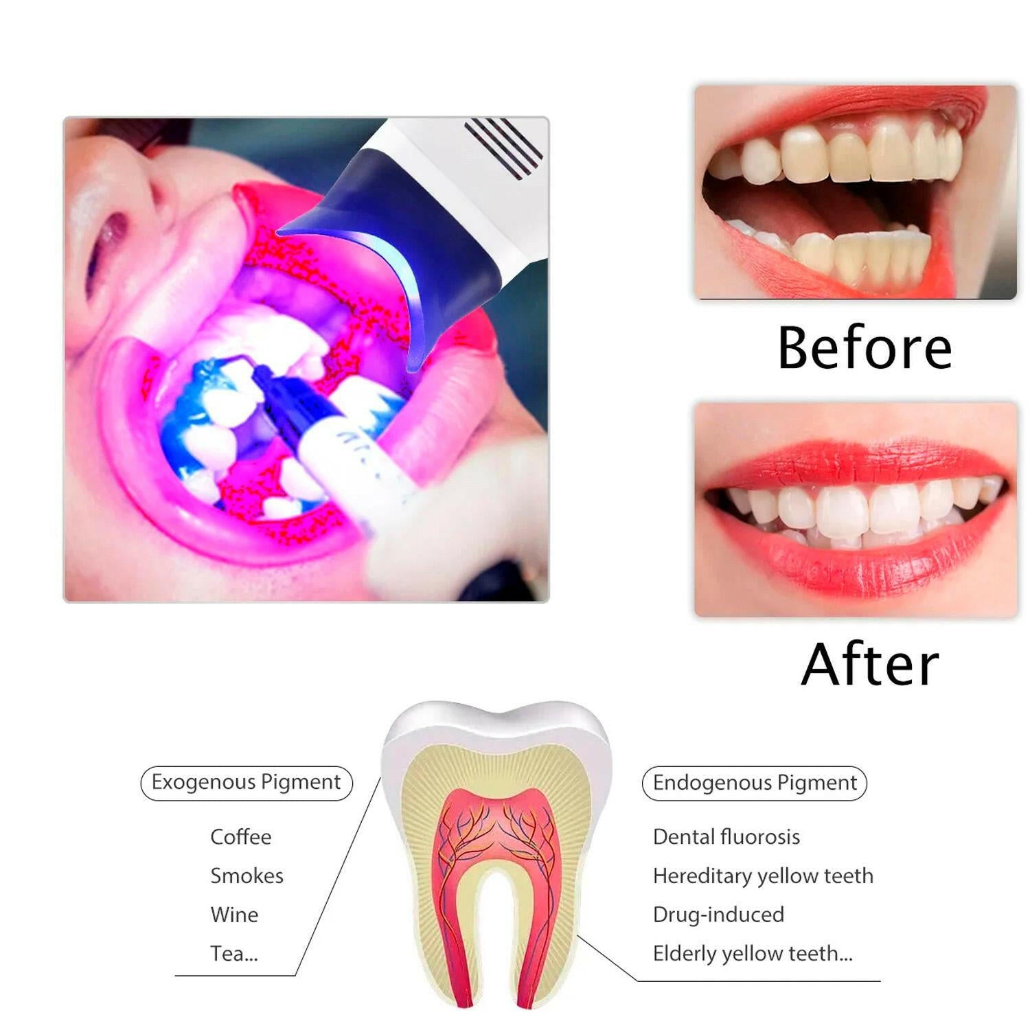 Lámpara Aceleradora De Blanqueamiento Dental De Pedestal.