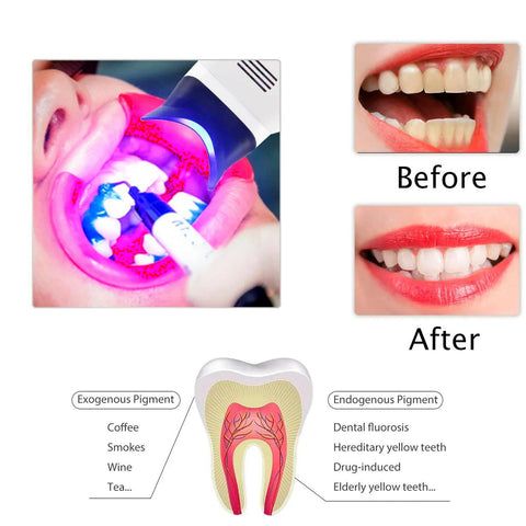 Lámpara Aceleradora De Blanqueamiento Dental De Pedestal.